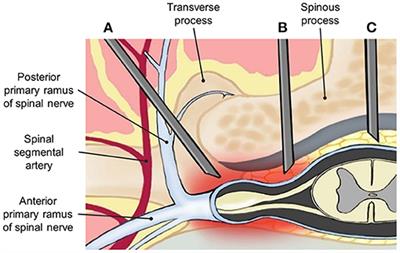 Parasagittal Approach of Epidural Steroid Injection as a Treatment for Chronic Low Back Pain: A Systematic Review and Meta-Analysis